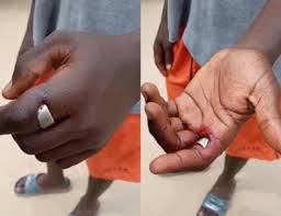 Teenager On Verge Of Losing Finger After Wearing Friend’s ‘Sakawa’ Ring