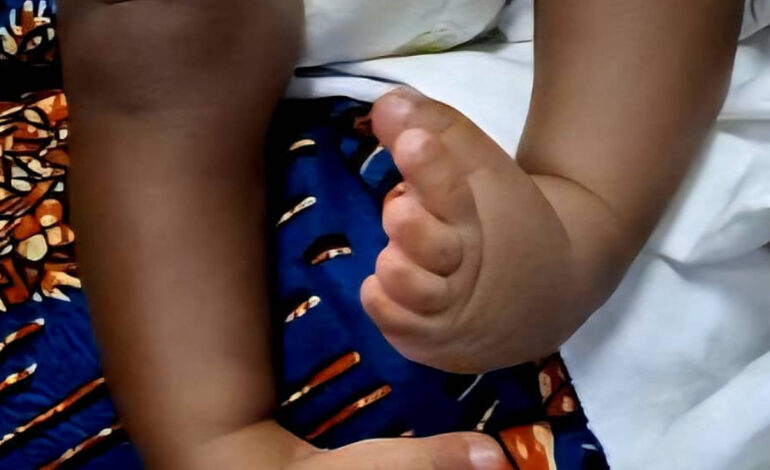Childhood Disability: Stakeholders urged to eliminate stigma associated with Clubfoot 