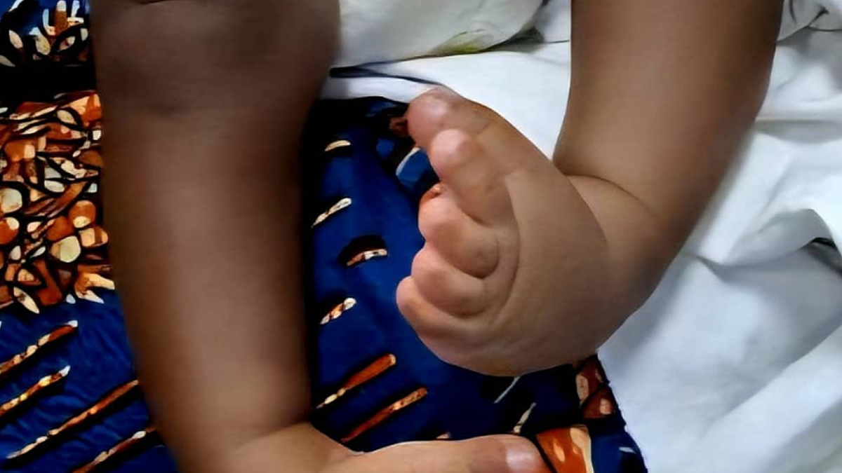 Childhood Disability: Stakeholders urged to eliminate stigma associated with Clubfoot 